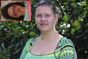 Момиче остана без око при удар с въздушна възглавница