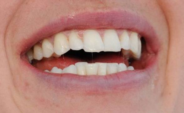 Как да предпазим устните си през зимата