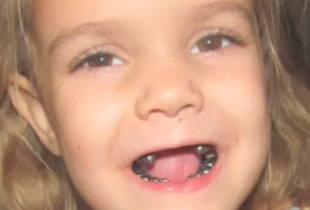 УЖАС! Зъболекар обезобрази 4-годишно момиче