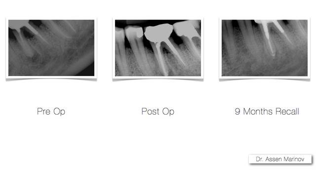 Лечение на гранулом