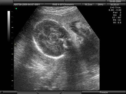 Какво е Скринингов тест?