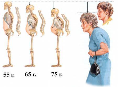 Изследвайте костите си ако сте застрашени от остеопороза