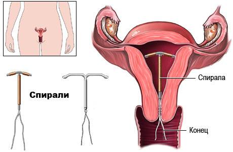 Вътрематочна спирала. Плюсове и минуси