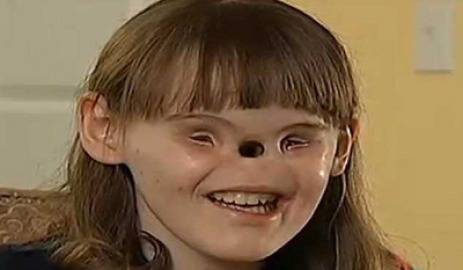 Уникално! Връщат очите и носа на момиче 16 години след раждането й (видео)