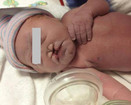 НЕВЕРОЯТНО! Хирурзи-виртуози сглобиха черепа на бебе!