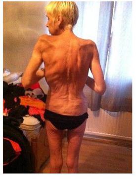 ШОК! Вижте трагедията на жената-скелет! (СНИМКИ и ВИДЕО)