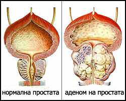 Аденом на простата