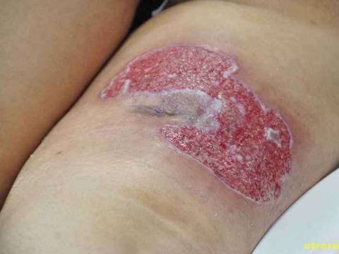 Ухапване от екзотично животно държи 40 дни бременна в болница