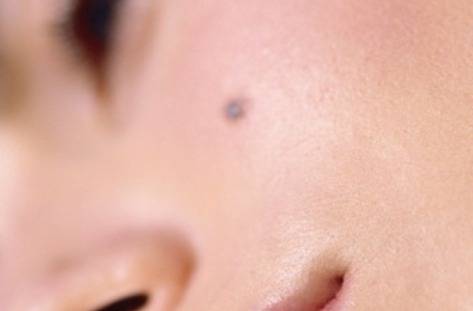 Безплатни прегледи за рак на кожата