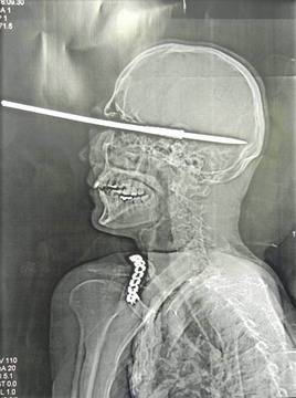 Рибар си простреля окото с харпун и оживя (СНИМКИ)