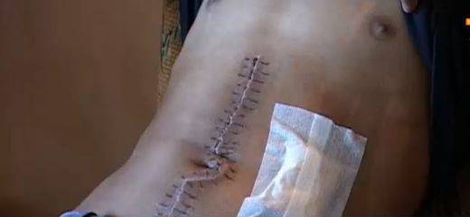 Ухажорът Гечо, с разпорения далак от бащата на любимата си, оздравява