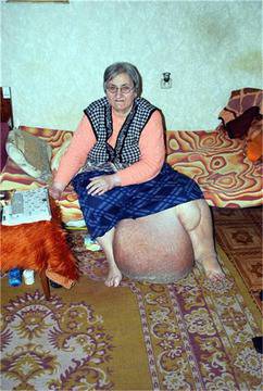 Свикват консилиум за жената със слонски крак