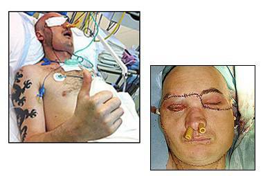 Извършиха животоспасяващата трансплантация на лице в Полша