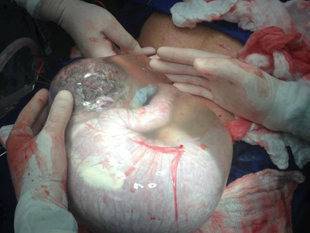 МЕДИЦИНСКИ ФЕНОМЕН! Вижте как се роди това бебе!