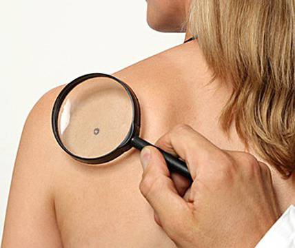 Премахване на брадавици със силата на мисълта!