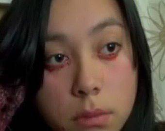 Куриоз! 20-годишно момиче плаче с кървави сълзи (видео)