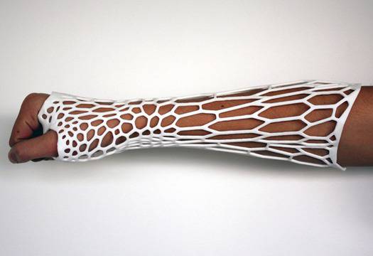 3D принтиран заместител на гипс при счупване