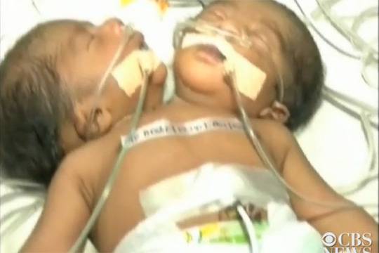 ФЕНОМЕНАЛНО! Роди се бебе с две глави