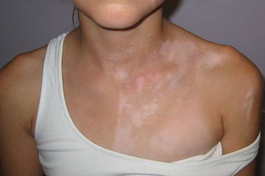 Как да се отървем от бели петна по кожата?