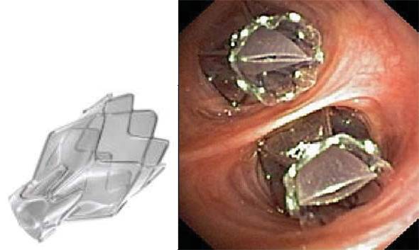 Терапевтични бронхоскопски процедури при авансирал белодробен емфизем