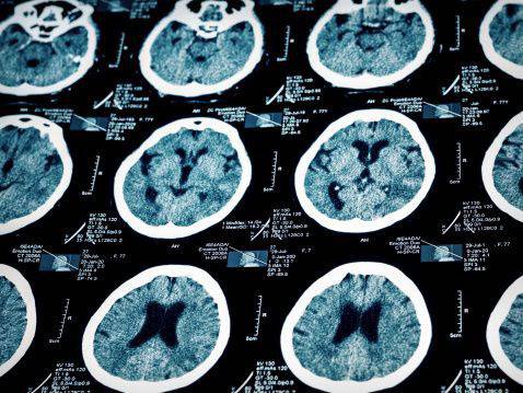 Нов тест може да открива Алцхаймер 10 г. преди появата на симптомите