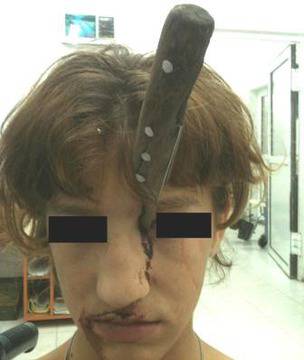 Брат заби нож в лицето на сестра си