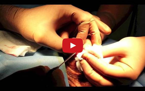 Лазерна операция при късо гемче