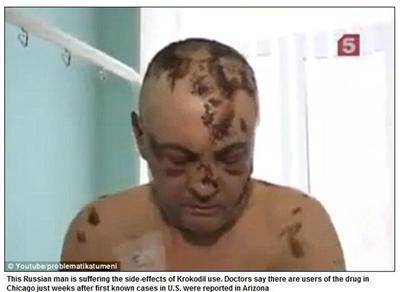 Руски „Крокодил“ разяжда плътта в САЩ