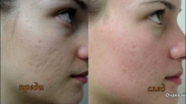 Как да премахнем акнето и белезите от него?