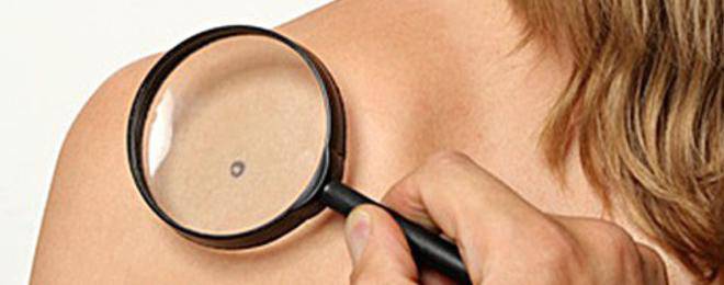 Лук и кислородна вода лекуват брадавици