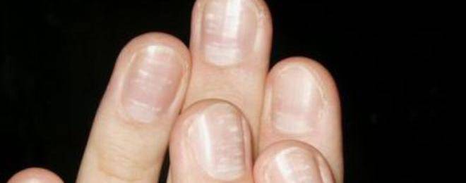 Белите петна по ноктите – защо се появяват и как се лекуват