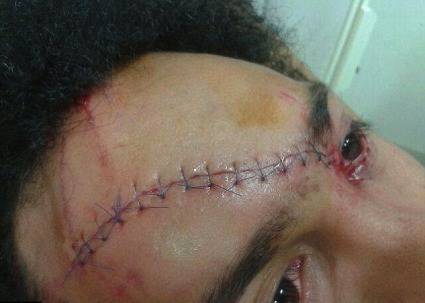 Зашиха с 13 шева челото на звезда в ръгбито