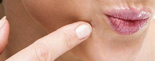 Рициновото масло маха брадавици