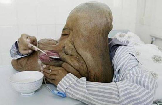 Хирурзи отстраниха чудовищен тумор от лицето на човека слон (снимки)