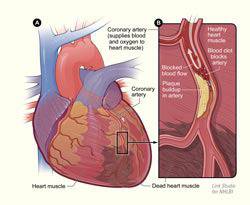 7 Heart Attack symptoms all women should know