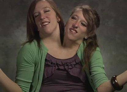 Двуглаво момиче живее в САЩ (видео)