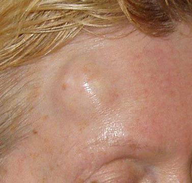 Д-р Румяна Кожухарова: Мастните бучки са безопасни тумори!