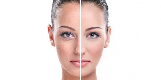 Как да премахнем пигментните петна от лицето си