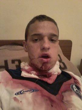 Футболист от „Б“ група със счупена челюст на три места след брутален шут в главата (снимки)