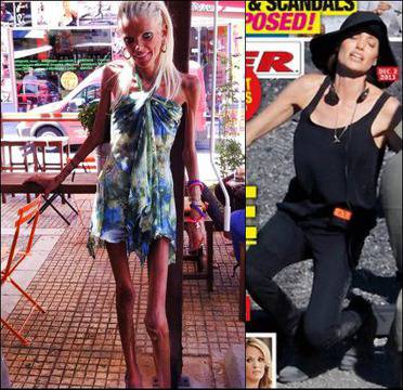 Нана Карагиани и Анджелина Джоли в топ 5 на звездните анорексички