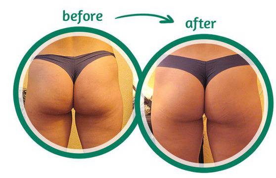 Няколко трика за борба с целулита