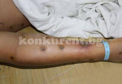 Рояк пчели атакува жена и я прати в болница с алергичен шок