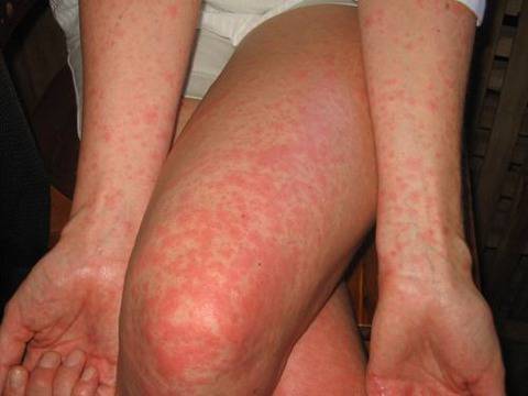 Кръвожадни дървеници налазиха Пловдив