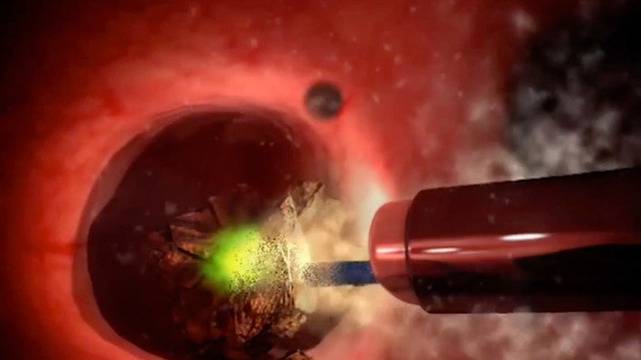 Как се лекуват камъни в бъбреците?