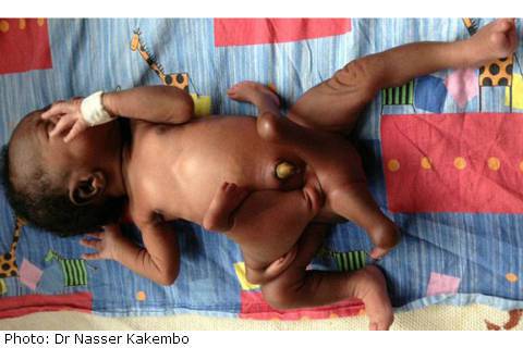 Дете-паяк: Бебе, родено с 4 ръце и 4 крака