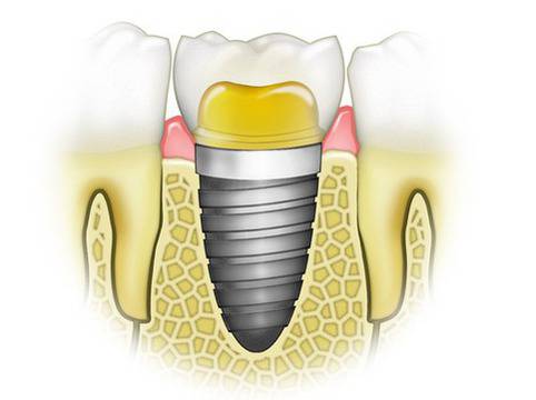 За и против зъбните импланти