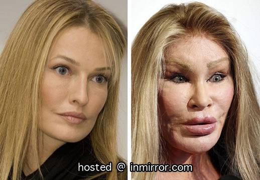 Вижте звездите преди и след пластични операции (СНИМКИ)