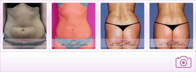 Липосукция – Премахване на целулит и натрупаната мастна тъкан от пластичния хирург д-р Ангел Енчев