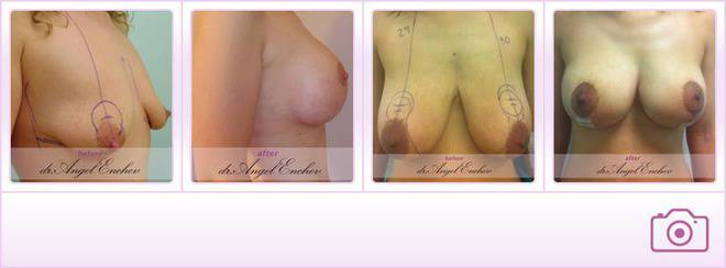 Намаляване на гърди и повдигане на бюст – Пластична хирургия д-р Ангел Енчев