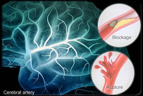 Учени разработиха метод за подхранване на мозъка след мозъчен инсулт